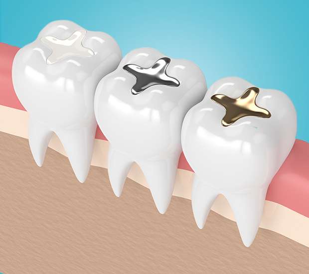 Philadelphia Tooth Colored Fillings