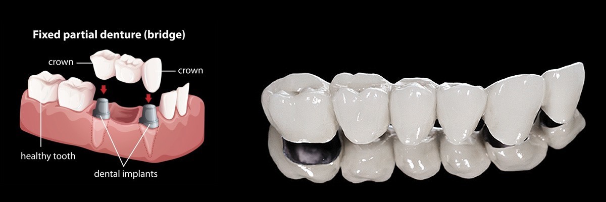 Philadelphia Dentures