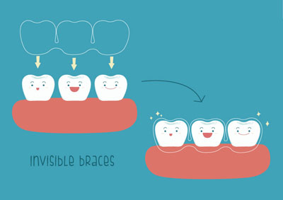 An Invisalign® Dentist Provides The Facts About Straightening Teeth
